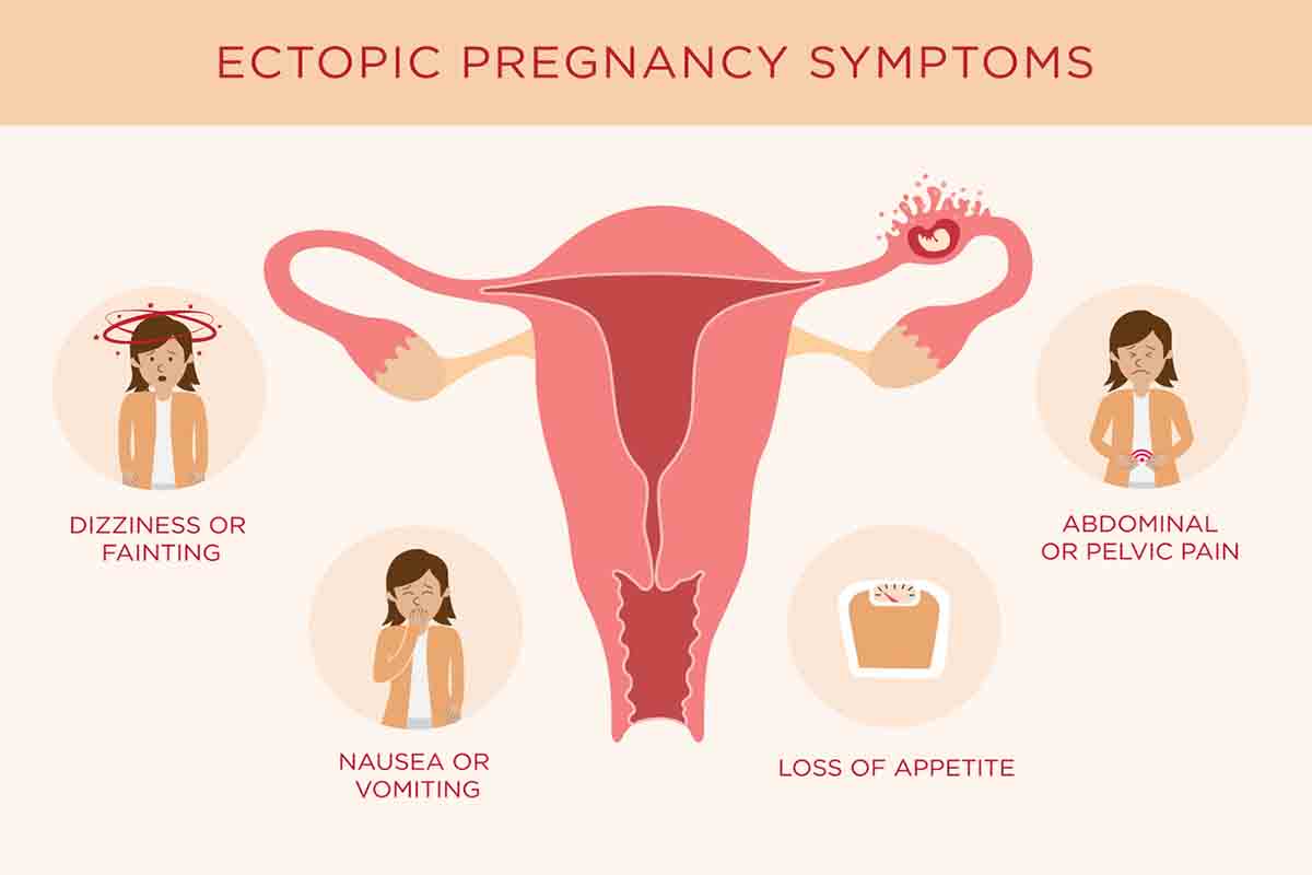Signs of Ectopic Pregnancy