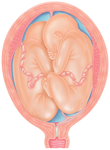 Twins in utero