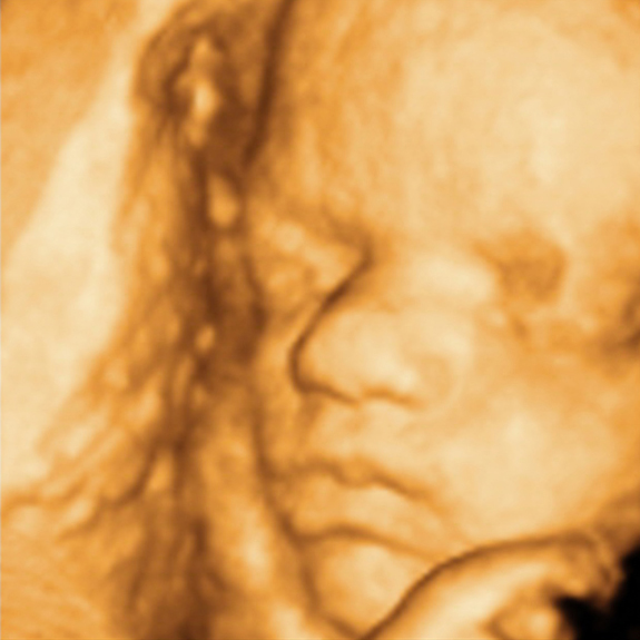 Ultrasound of Fetus at 34 Weeks