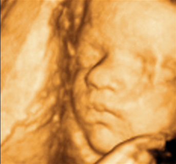 Fetus 25 Weeks 5 Days