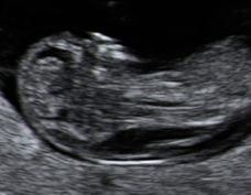 Ultrasound of fetus