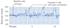 External fetal monitoring graph