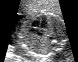 20 week ultrasound of fetus