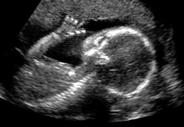 20 week ultrasound of fetus