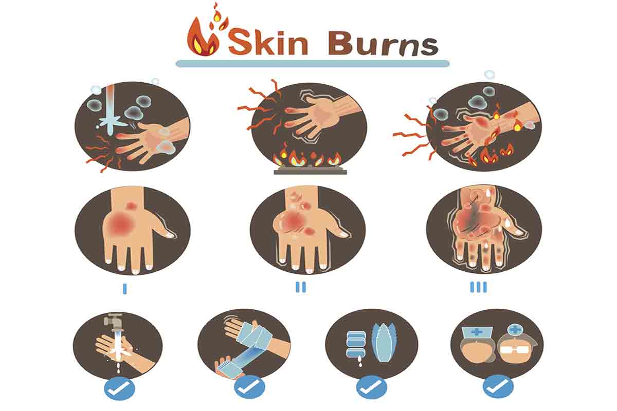 Burn Treatment