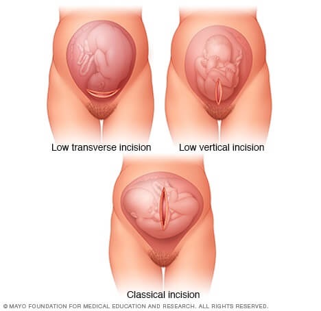 Types of C-Section Incisions