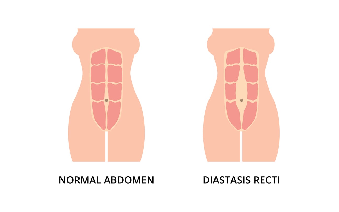 Illustration of Diastasis Recti vs normal abdomen 