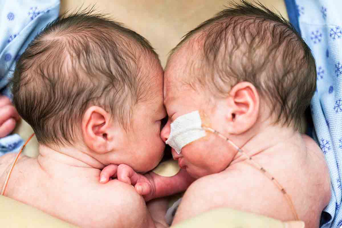 Increased Risk for Mono Di Twins