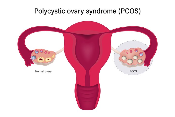 What Is Polycystic Ovarian Syndrome?