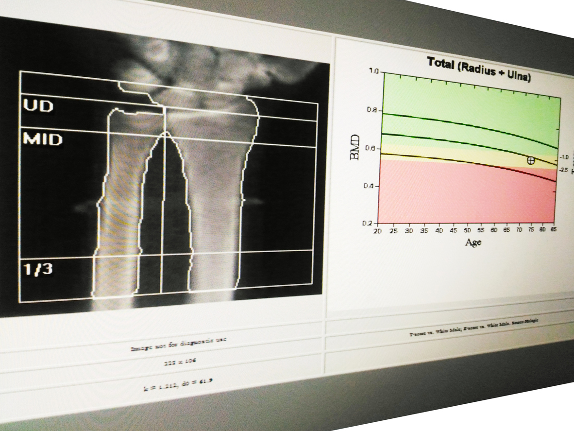 Soft and blurry image: special examination medical image wrist bone density on white background.