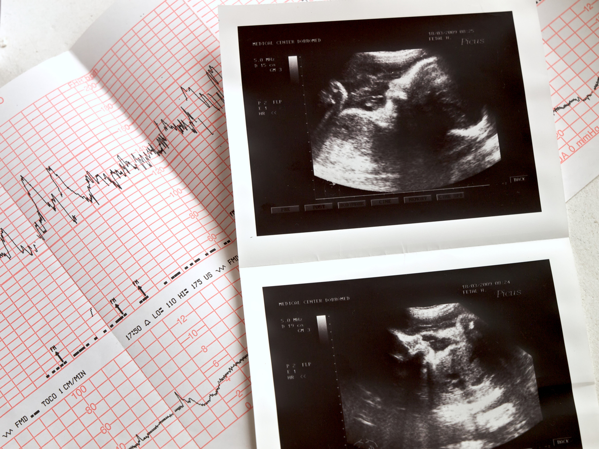 When Can Ultrasound Detect a Baby’s Heartbeat?