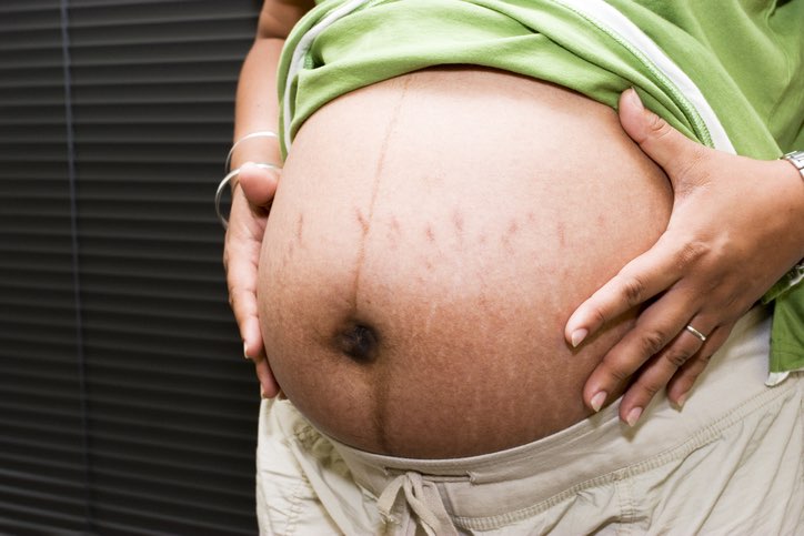 Why Does Hyperpigmentation Occur during Pregnancy?