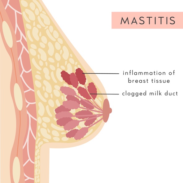 What is Mastitis?