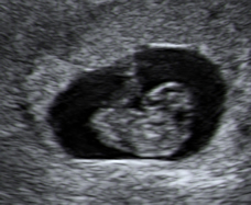 Weeks ultrasound 8 pregnant Ultrasound at