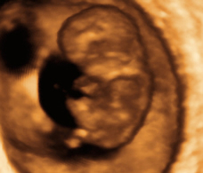 ultrasound of human fetus at 10 weeks and 2 days