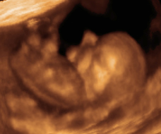 ultrasound of human fetus at 11 weeks and 1 day
