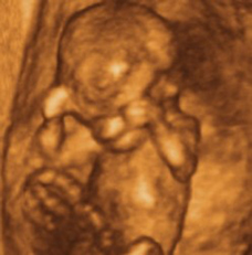 ultrasound of human fetus at 11 weeks and 3 days