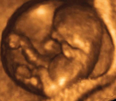 ultrasound of human fetus at 12 weeks exactly