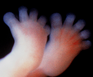 feet of human fetus at 12 weeks and 1 day