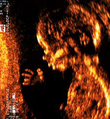 ultrasound of human fetus at 13 weeks and 1 day