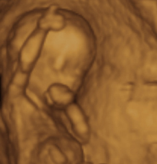 ultrasound of human fetus at 13 weeks and 5 days