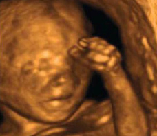 ultrasound of human fetus at 17 weeks and 5 days