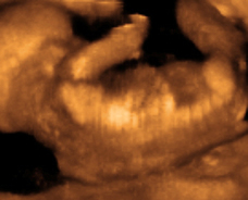 ultrasound of human fetus at 18 weeks and 6 days