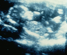 ultrasound of human fetus at 20 weeks and 4 days