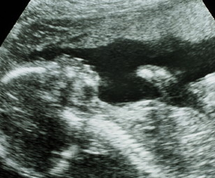 ultrasound of human fetus at 22 weeks and 4 days
