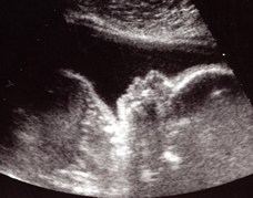 ultrasound of human fetus at 25 weeks and 1 day