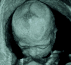 ultrasound of human fetus as 28 weeks and 6 days
