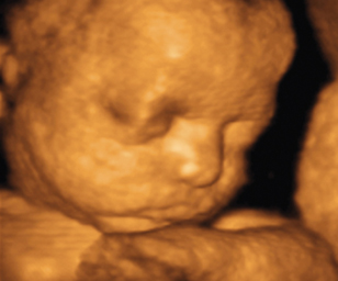 ultrasound of human fetus at 32 weeks and 4 days