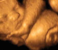 ultrasound of human fetus at 33 weeks and 5 days