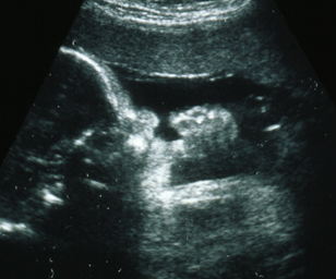 ultrasound of human fetus at 34 weeks and 4 days