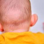 What Is Dolichocephaly in Newborns?