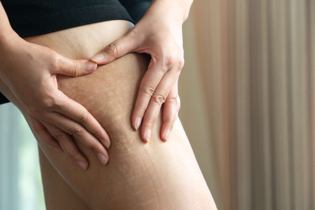 Teen Stretch Marks and Growing Pains: Causes and Treatments
