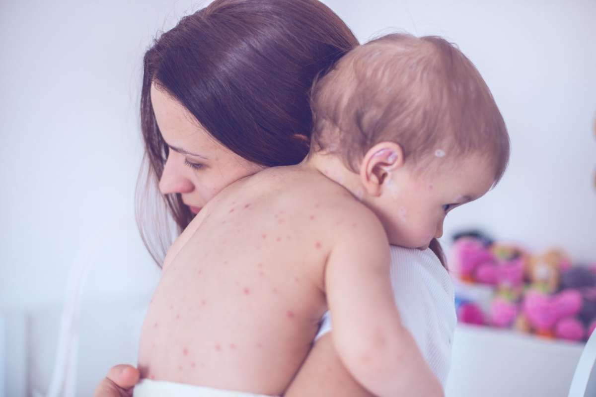 What Is the Ideal Chickenpox Vaccine Age?