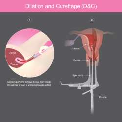 Is Dilation and Curettage (D&C) After Miscarriage the Same as Abortion?