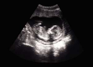 ultrasound of a fetus 35 weeks 3 days
