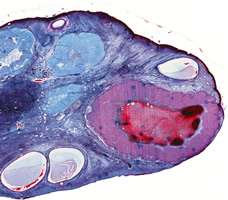 empty egg follicle in the ovary