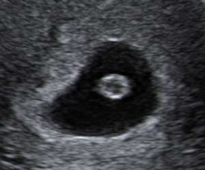 ultrasound of human embryo at 7 weeks exactly