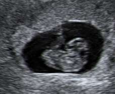ultrasound of human embryo at 8 weeks and 3 days