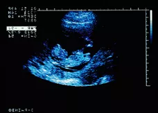 ultrasound of human fetus at 10 weeks and 3 days