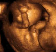 ultrasound of human fetus at 18 weeks and 2 days