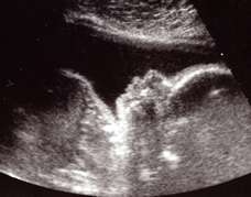 ultrasound of human fetus at 25 weeks and 1 day