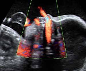 ultrasound of human fetus as 26 weeks and 2 days