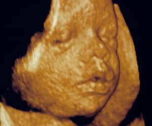 ultrasound of human fetus 31 weeks and 1 day