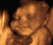 ultrasound of human fetus 32 weeks and 3 days