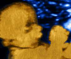 ultrasound of human fetus at 33 weeks and 1 day