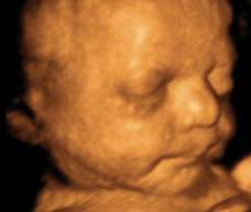 ultrasound of human fetus at 33 weeks and 3 days
